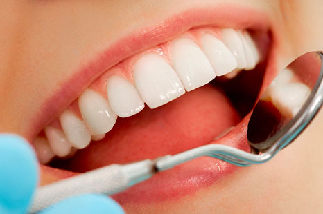 White Dental Fillings